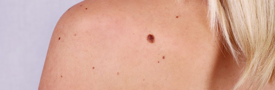 Being SunSmart in Summer